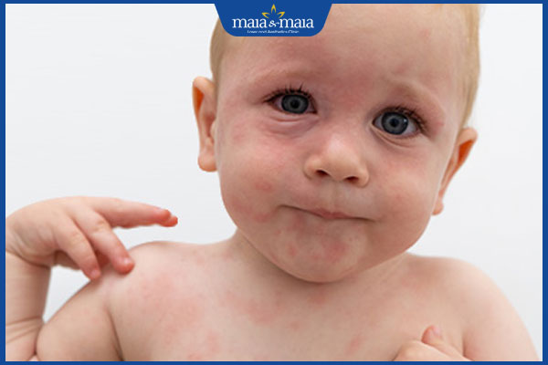 trẻ em bị dị ứng với sữa