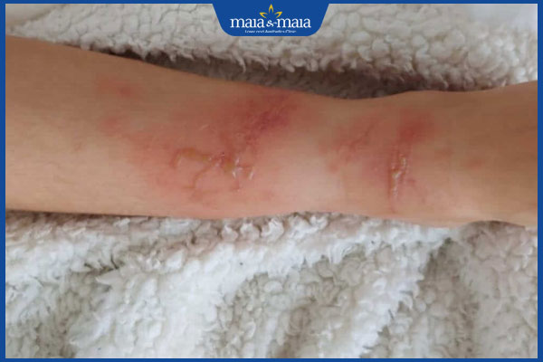 trẻ nhỏ bị dị ứng sứa