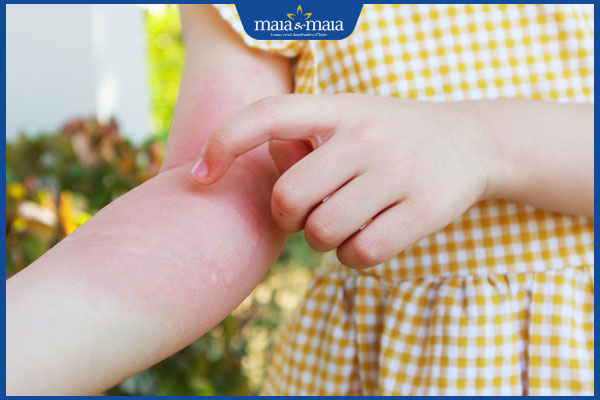 Dị ứng ở trẻ do đâu? Cách xử lý và phòng ngừa an toàn cho bé 3 trẻ nổi mề đay gãi nhiều