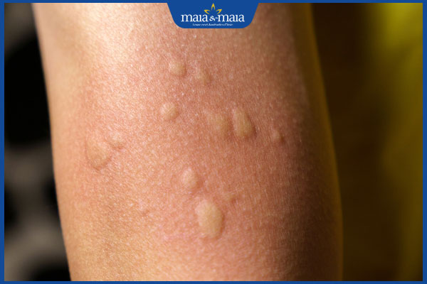 trẻ nổi mề đay