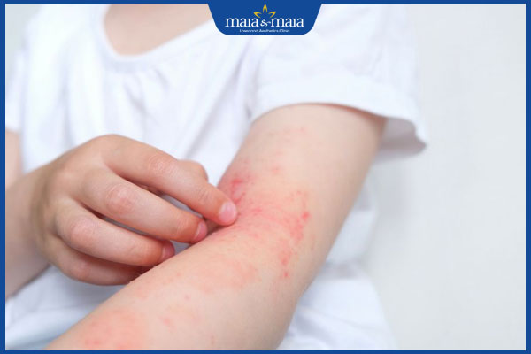 Trẻ bị dị ứng thời tiết: Dấu hiệu, nguyên nhân và cách xử lý 2 trẻ nổi phát ban trên da