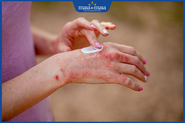 trị dị ứng da tay