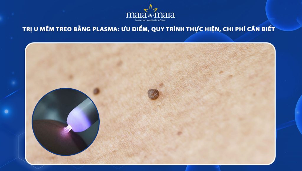 trị u mềm treo bằng plasma