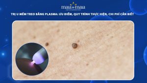 trị u mềm treo bằng plasma