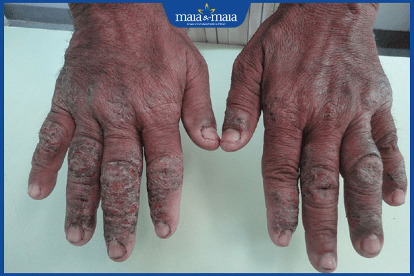 triệu chứng dị ứng xi măng