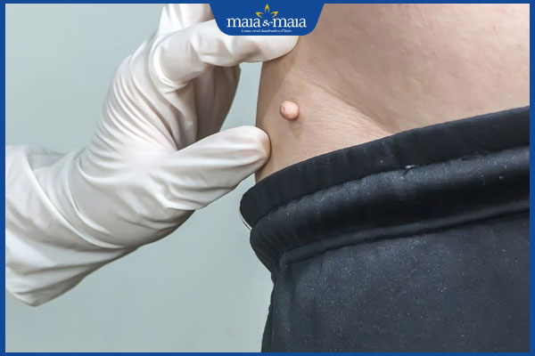 Mọc u mềm treo do đâu? Dấu hiệu và cách điều trị hiệu quả 4 u mềm treo mọc ở hông