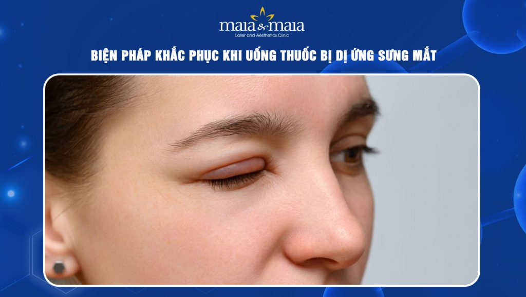 Uống thuốc bị dị ứng sưng mắt