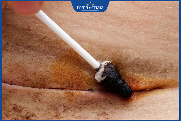 vệ sinh vết mổ