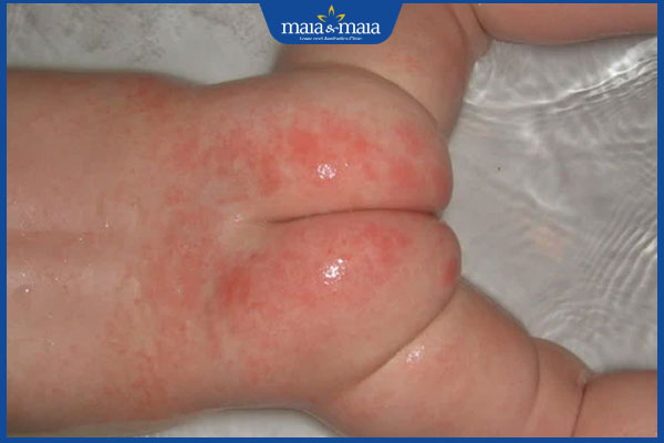 viêm da mông ở trẻ