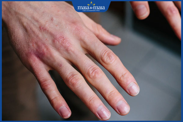 viêm da tiếp xúc bột giặt