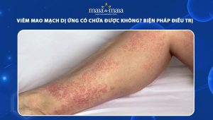 viêm mao mạch dị ứng chữa được không