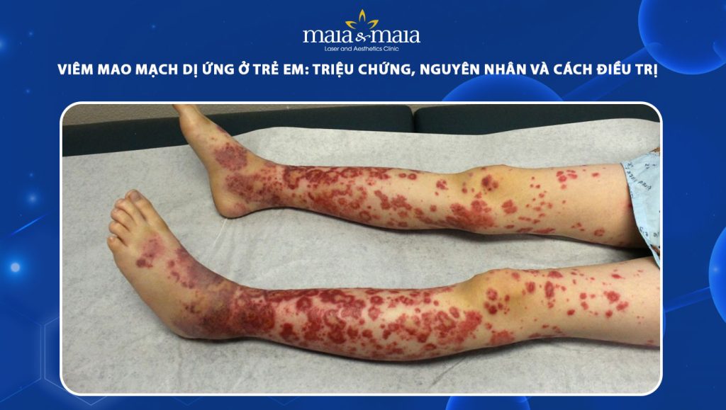 viêm mao mạch dị ứng ở trẻ em