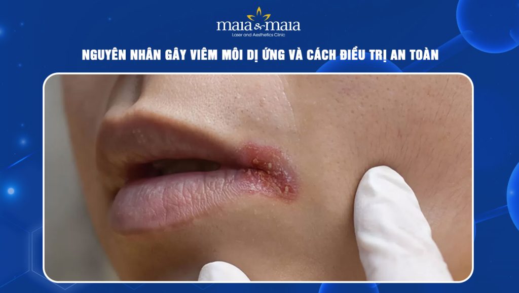 Viêm môi dị ứng