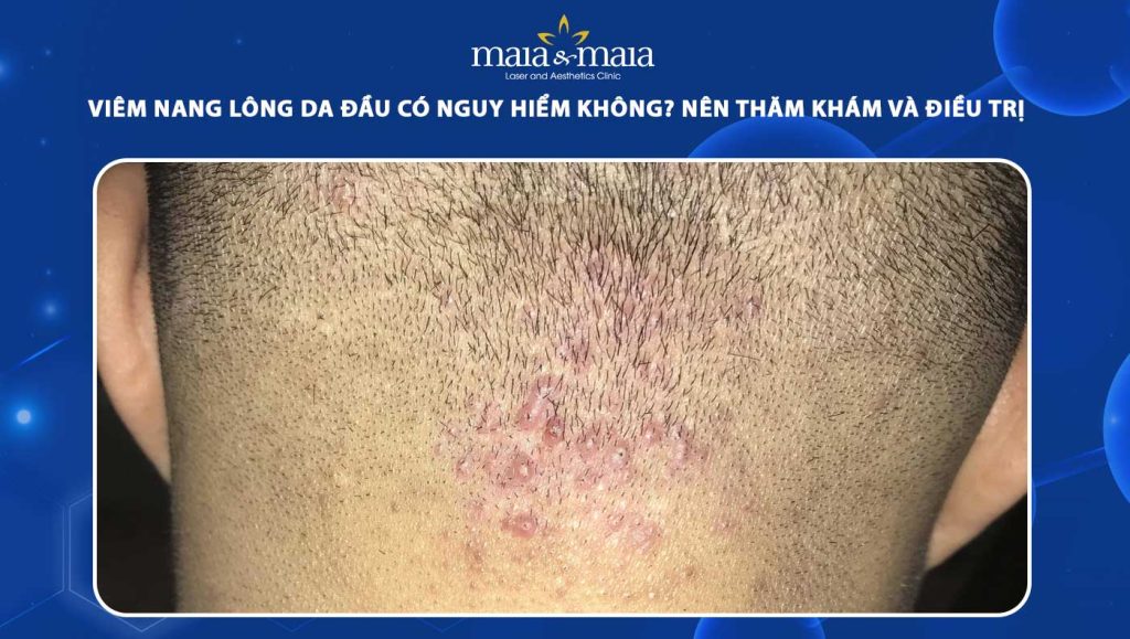Viêm nang lông da đầu là gì? Cách xử lý, phòng ngừa hiệu quả 1 viêm nang lông da đầu