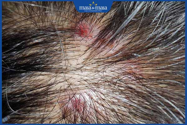 Viêm nang lông da đầu là gì? Cách xử lý, phòng ngừa hiệu quả 4 viêm nang lông da đầu do vi khuẩn