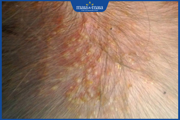 Viêm nang lông da đầu là gì? Cách xử lý, phòng ngừa hiệu quả 3 viêm nang lông đầu ái toan