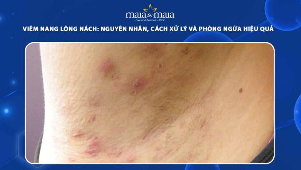 viêm nang lông nách