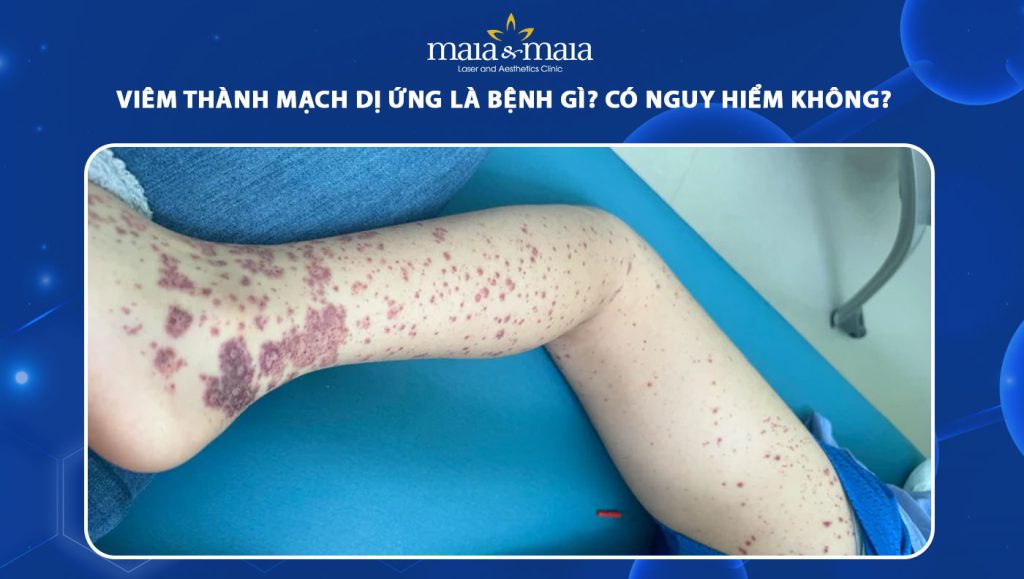 viêm thành mạch dị ứng