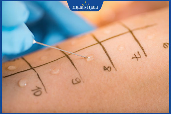 xét nghiệm chích da