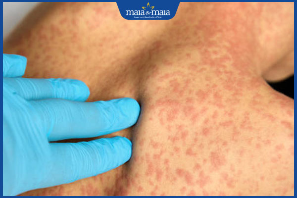 bác sĩ chẩn đoán hồng ban