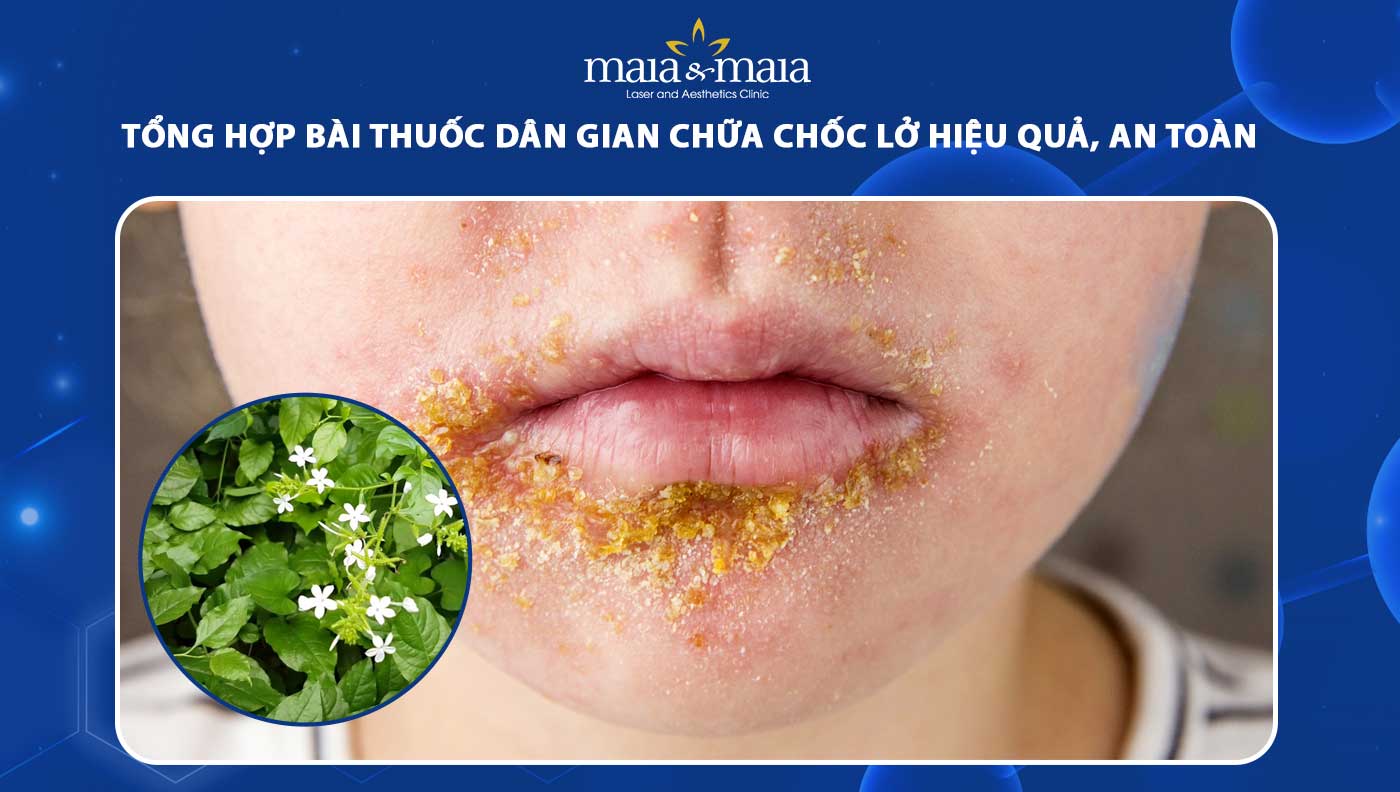 bài thuốc dân gian chữa chốc lở