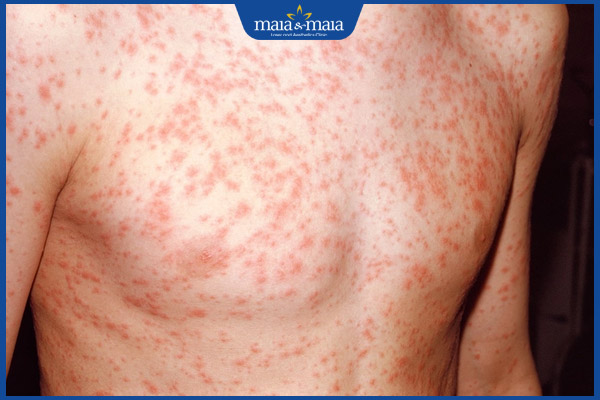 ban đỏ khắp người