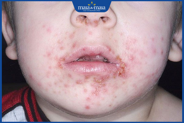 bệnh chốc khởi phát