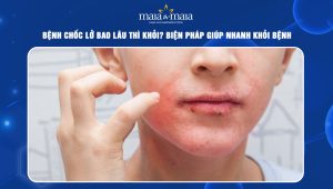 bệnh chốc lở bao lâu thì khỏi