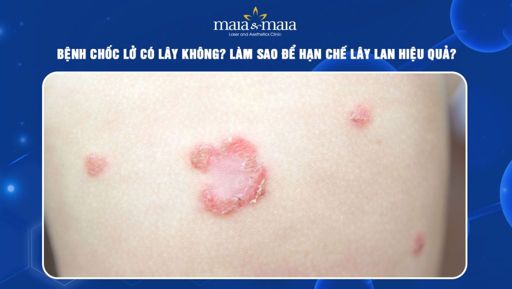 Bệnh chốc lở có lây không? Làm sao để hạn chế lây lan? 1 bệnh chốc lở có lây không