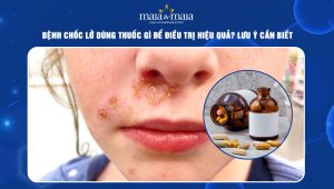 bệnh chốc lở dùng thuốc gì