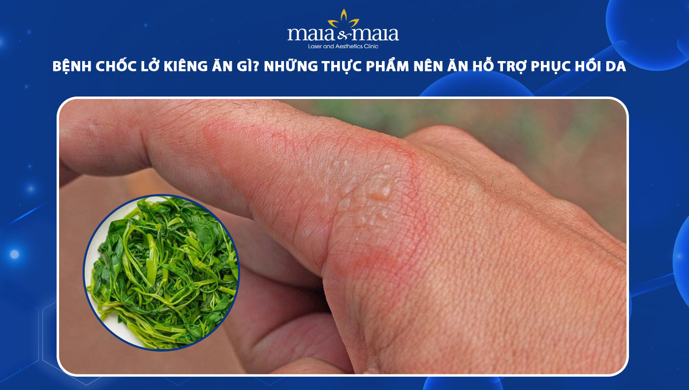 bệnh chốc lở kiêng ăn gì