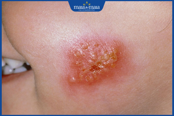 bệnh chốc nổi mụn