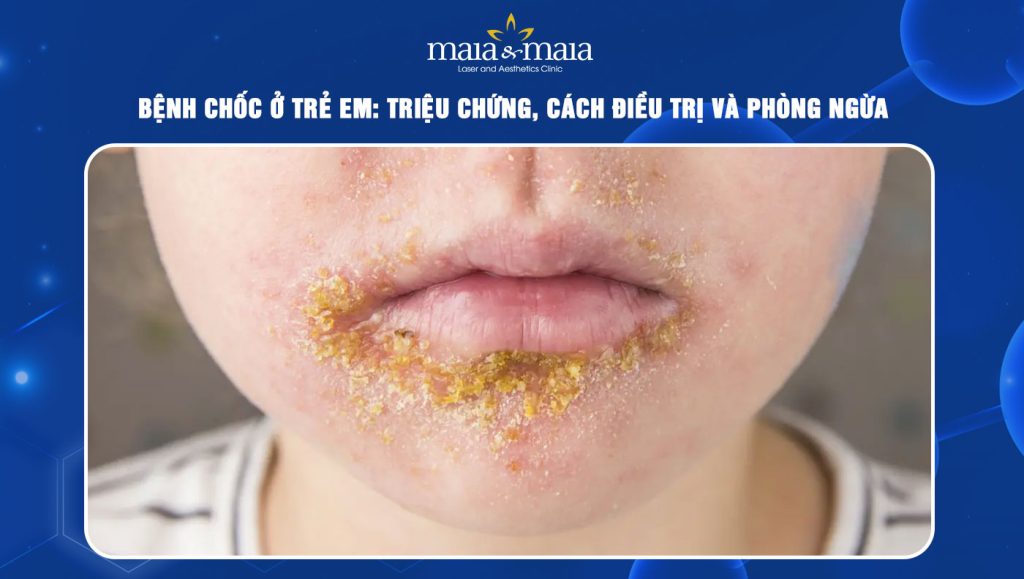 bệnh chốc ở trẻ em