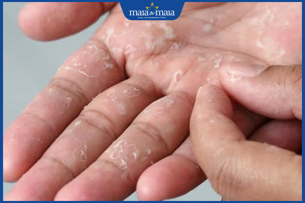 bị bong tróc ở tay