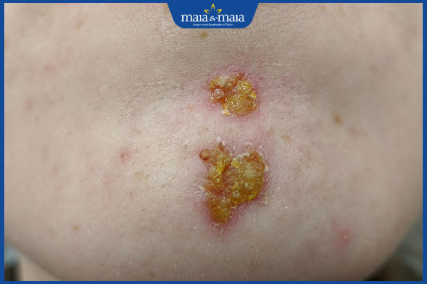 bị chốc lở ở cằm