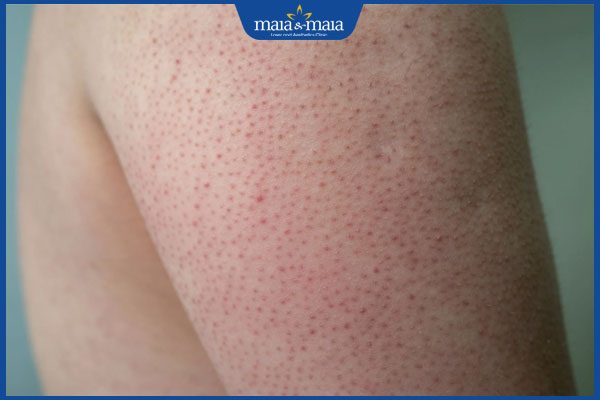 bị dày sừng nang lông ở tay