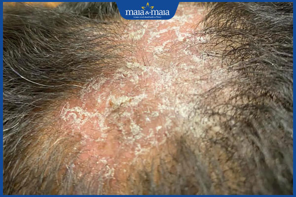 bị rụng tóc do lupus ban đỏ