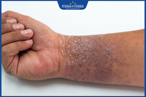 Viêm da atopy do đâu? Gợi ý cách điều trị hiệu quả 3 bị viêm da atopy