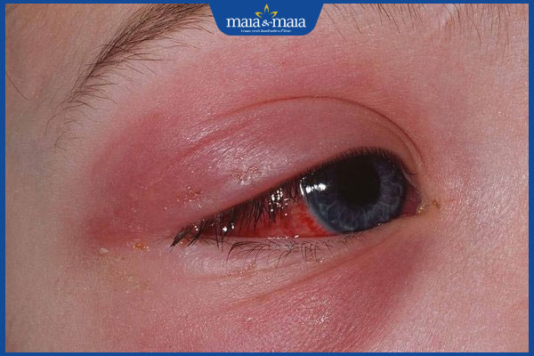 Viêm mô tế bào hốc mắt là gì? Nguyên nhân và cách điều trị 3 bị viêm mô tế bào hốc ma