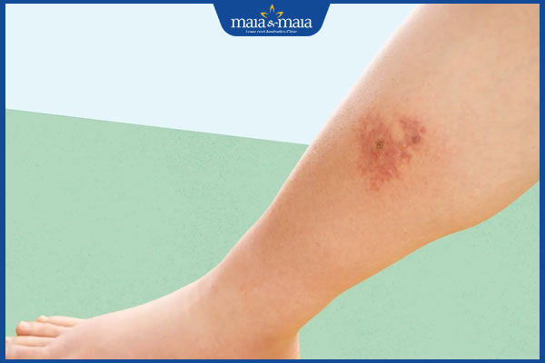 bị viêm mô tế bào