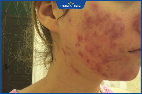 biến chứng viêm da mụn mủ