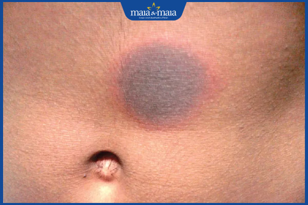 biểu hiện hồng ban sắc tố