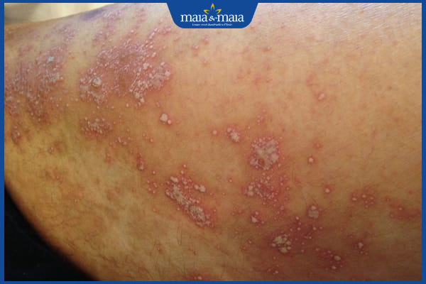 biểu hiện phát ban mủ