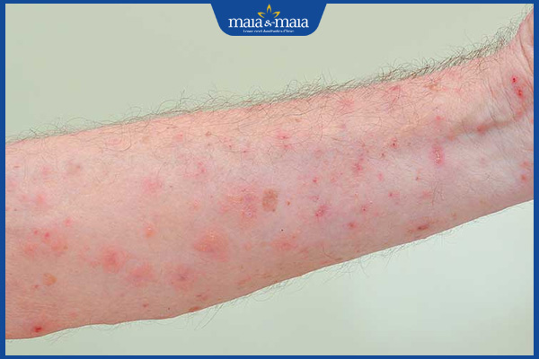 biểu hiện phát ban