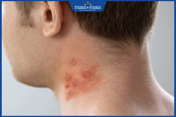 biểu hiện sẩn ngứa