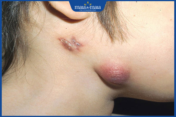 Chốc lở dạng phỏng có nguy hiểm không? Phương pháp điều trị 3 biểu hiện viêm hạch