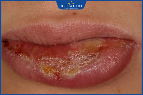Nhận biết các dạng viêm môi thường gặp và hướng điều trị 5 biểu hiện viêm môi tuyến