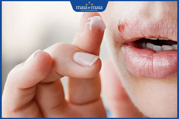 Bệnh chốc lở bao lâu thì khỏi? Cách giúp nhanh khỏi bệnh 2 bôi chữa chốc mép