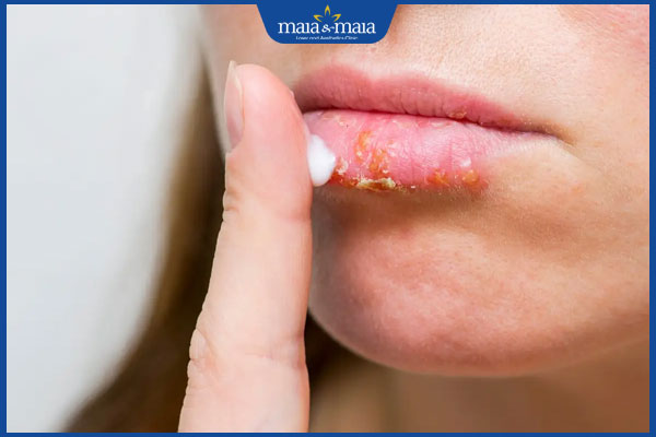 bôi thuốc lên môi