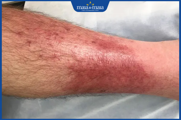 Viêm mô tế bào: Phương pháp chẩn đoán và điều trị hiệu quả 3 cẳng chân viêm mô